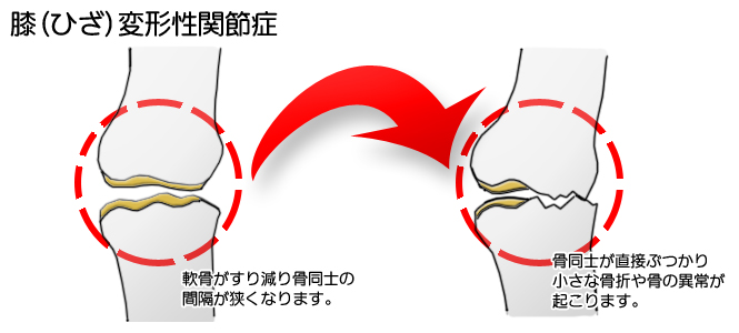 膝変形性関節症